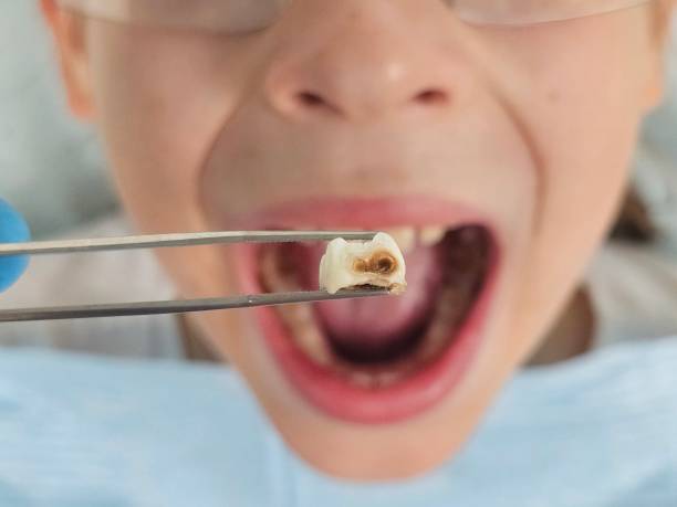 Best Emergency Dentist for Lost Fillings or Crowns in Vega, TX